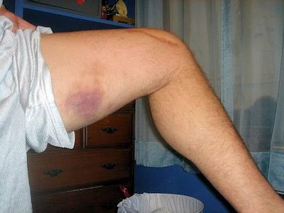 bruise