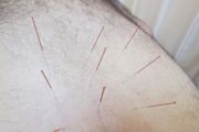 Sias Campus Acupuncture Clinic Photo 9