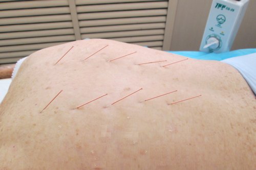 Bernice Has 10 Needles in Her Back - Scene 16